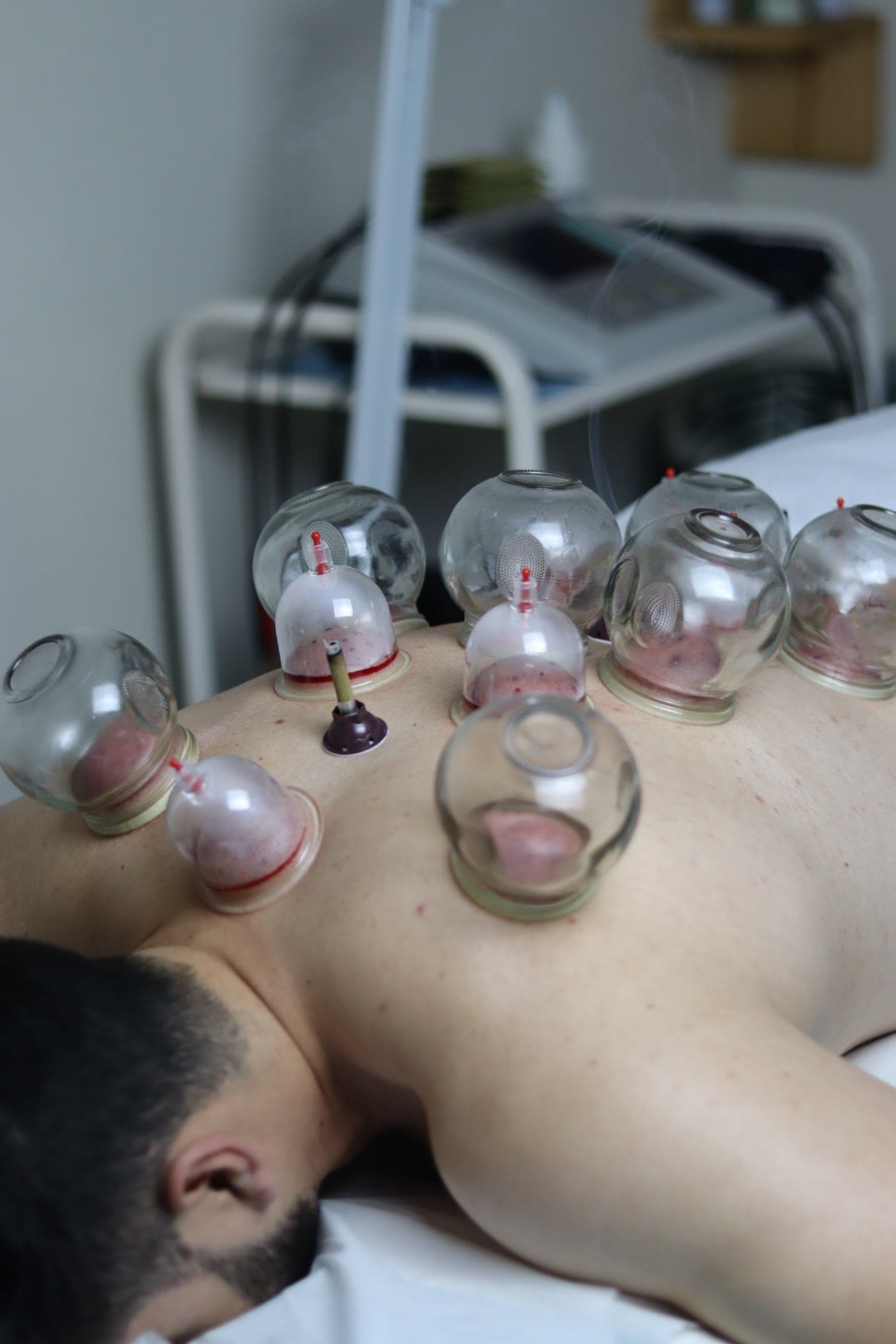 Séance de hijama associée à la moxathérapie