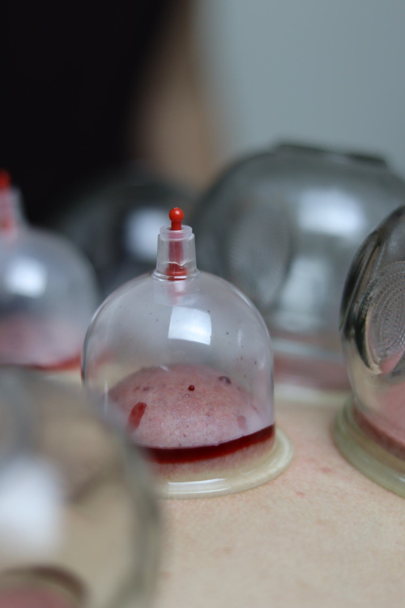 Gros plan sur une ventouse de hijama, avec présence de sang