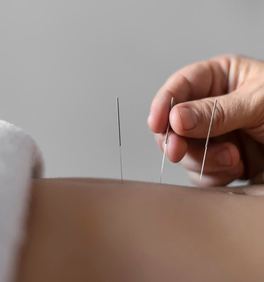 Aiguilles d'acupuncture posées sur le dos