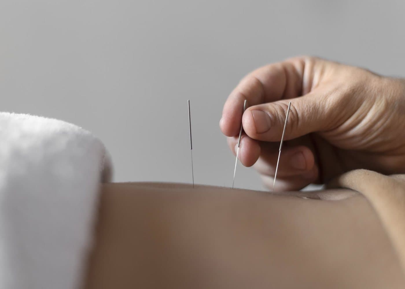 Pose d'aiguilles d'acupuncture sur le dos d'un patient