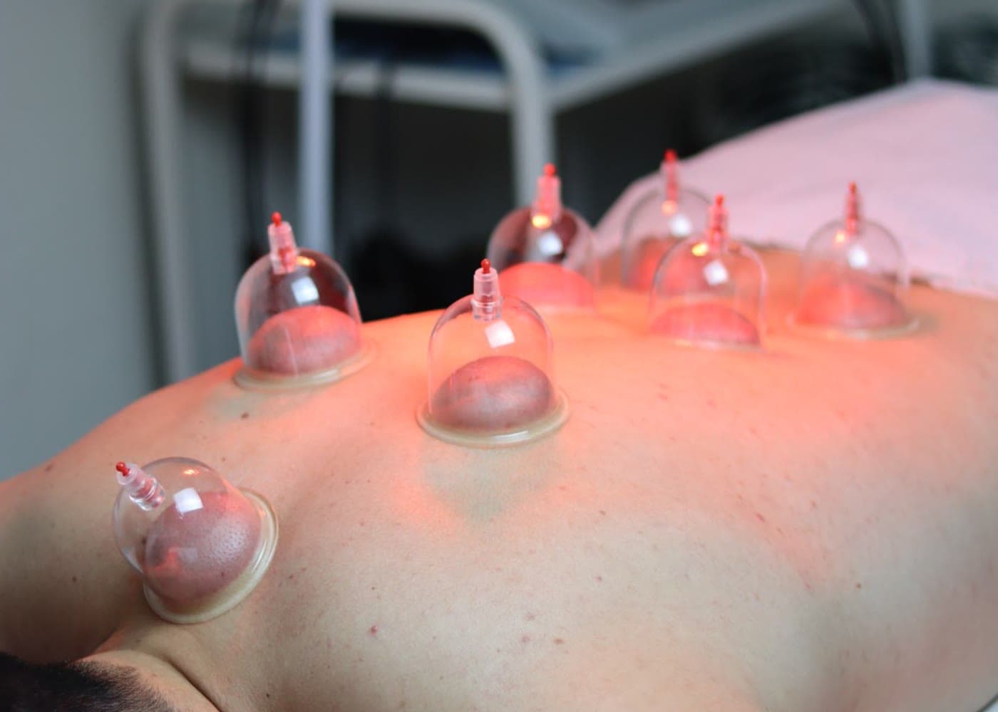 Ventouses posées sur le dos d'un patient sous lumière infrarouge